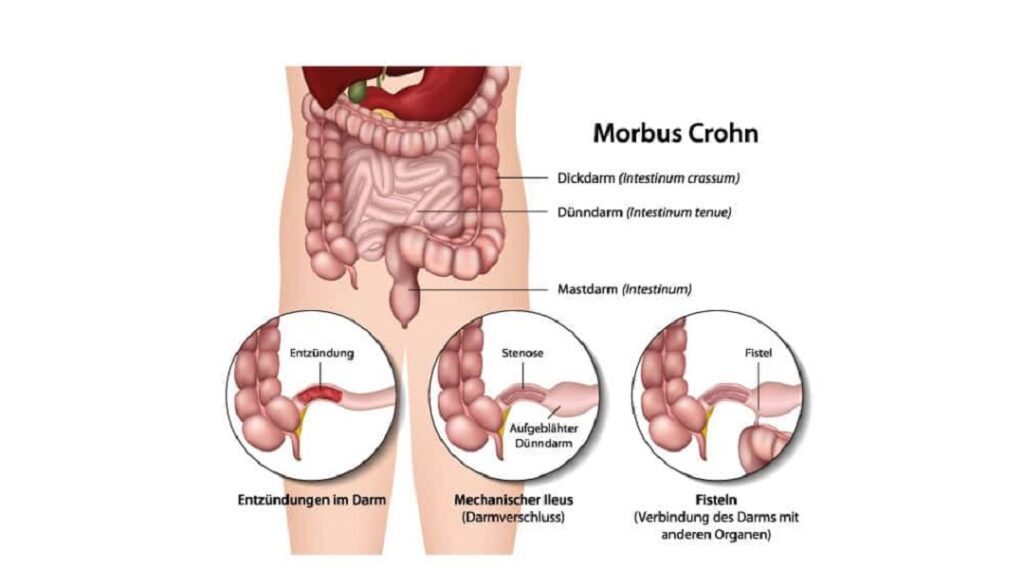 Morbus Crohn