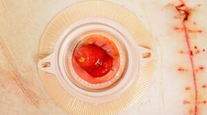 Hautschutz Stoma, Hautschutzmittel