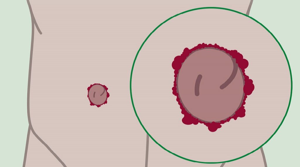 Stoma-Granulome