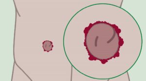 Stoma-Granulome