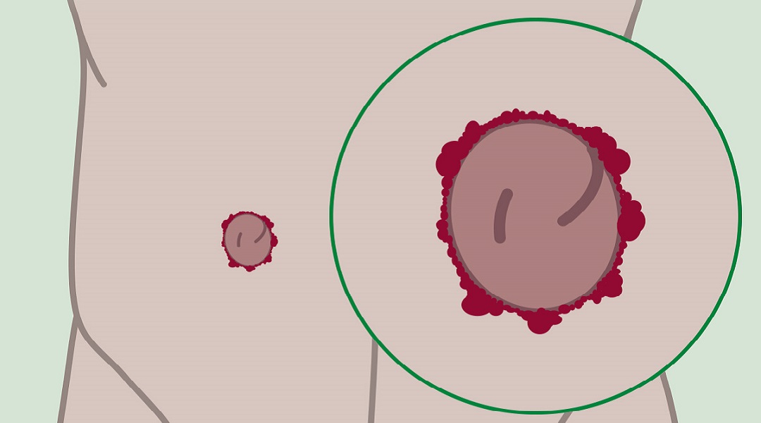 Stoma-Granulome