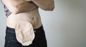 Stoma-Komplikationen