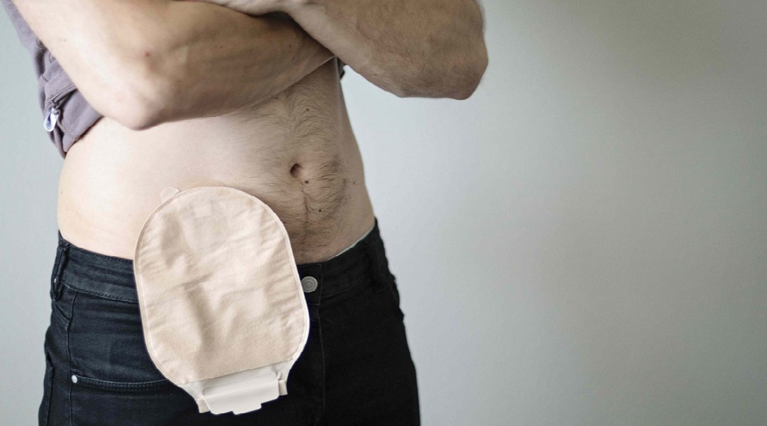 Stoma-Komplikationen