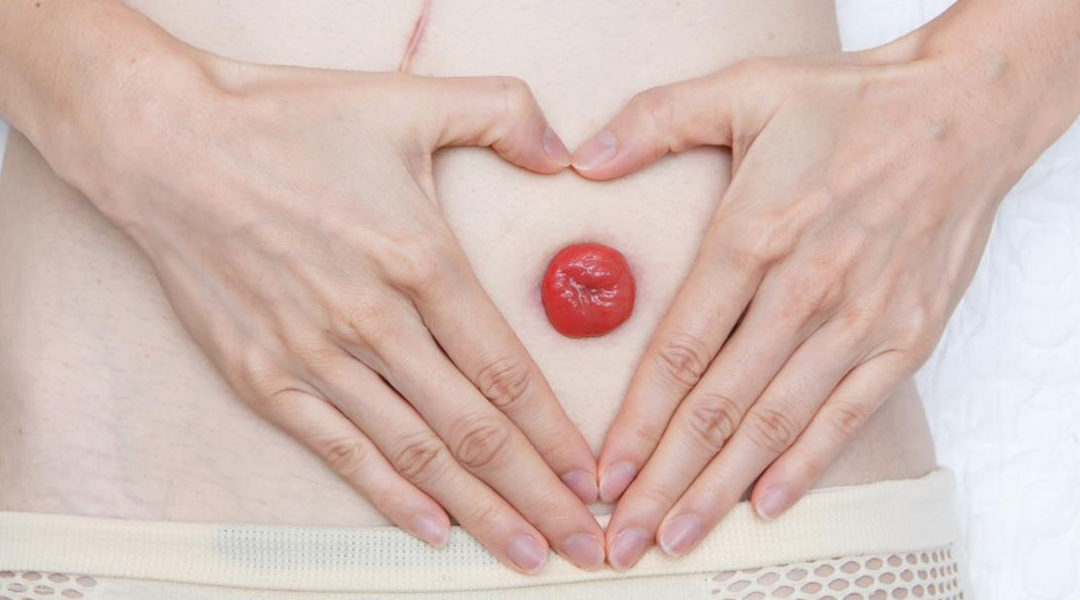 Stomaversorgung bei der GHD, Therapiebereich Stoma