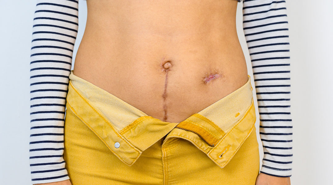 Stomarückverlegung nach der Stoma-Op