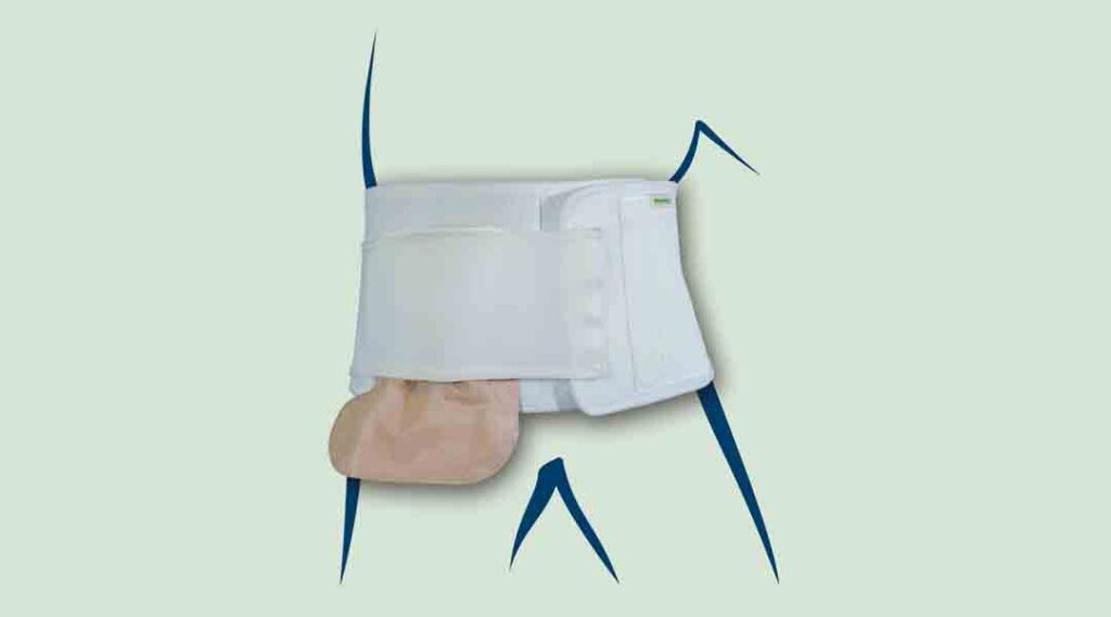 Stomabandage, Bandagenversorgung, Parastomale Hernien-Prävention