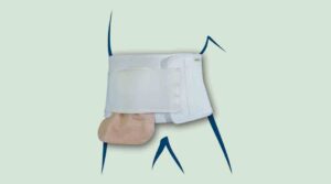Stomabandage, Bandagenversorgung, Parastomale Hernien-Prävention