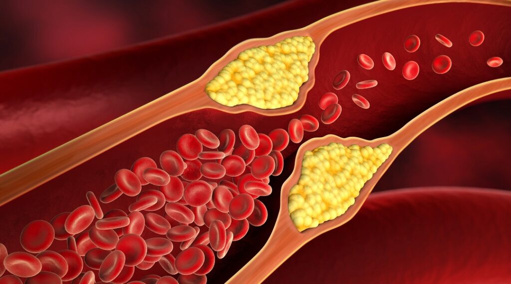 Diabetisches Fußsyndrom Gefäßverengung