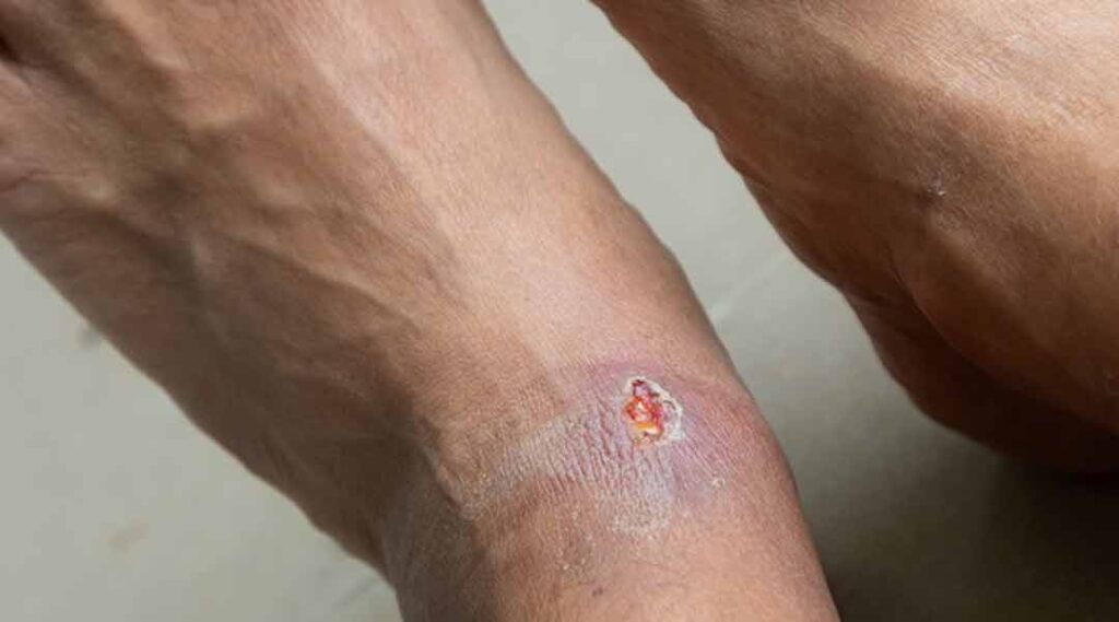 Diabetisches Fußsyndrom