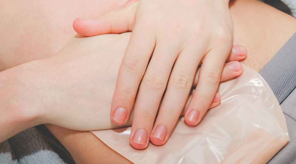 Eine Frau hält ihren Bauch. Mögliche Stoma-Komplikationen können vorliegen.