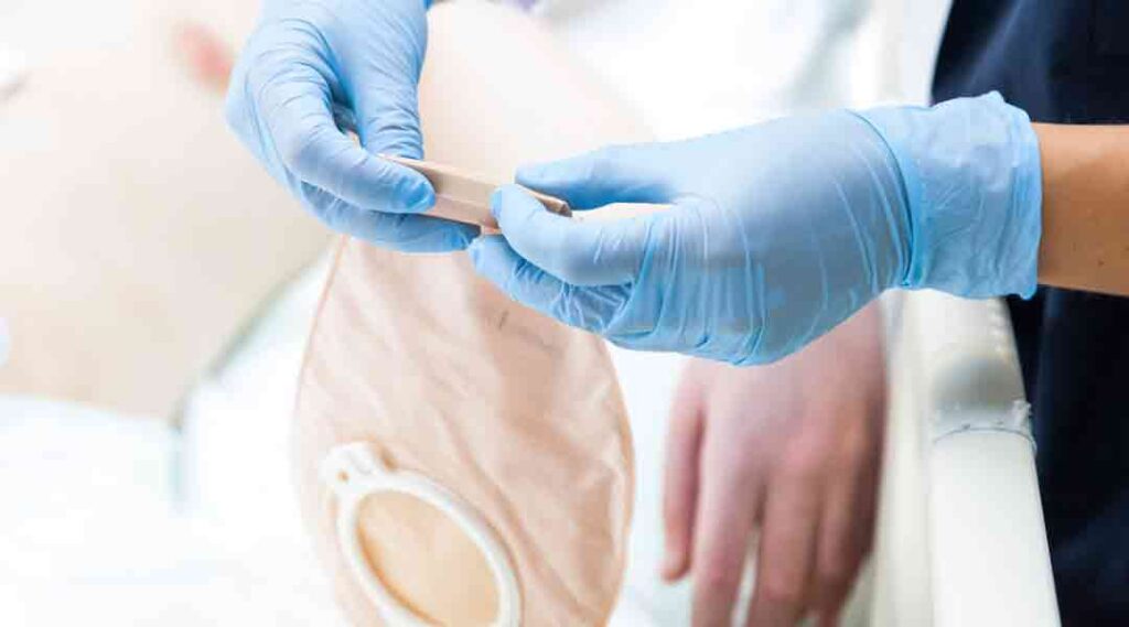 Fruehkomplikationen bei Stoma, Stoma Komplikationen, zweiteilige Versorgung