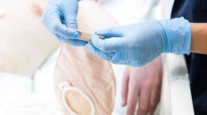 Fruehkomplikationen bei Stoma, Stoma Komplikationen, zweiteilige Versorgung