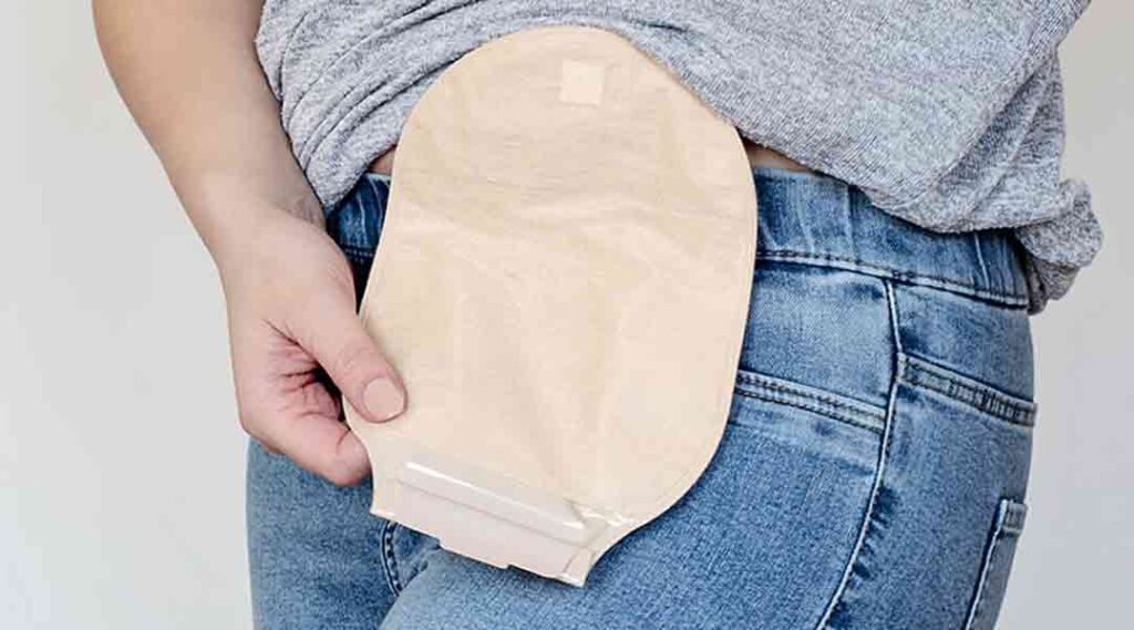 Stomabeutel über der Hose, Ileostoma