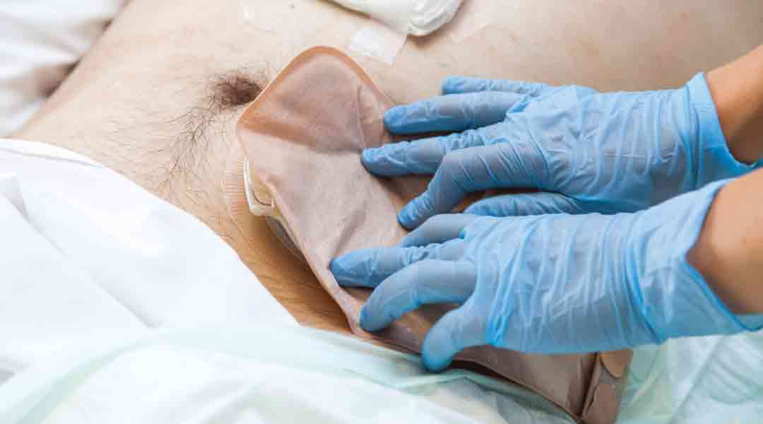 Ursachen für Stoma Komplikationen