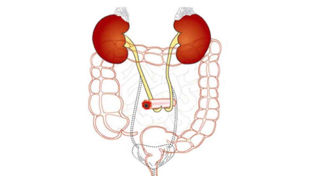 Urostoma, Urostomie-Versorgung